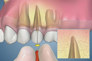 Retreatment-Overfilled Mechanical-Technique